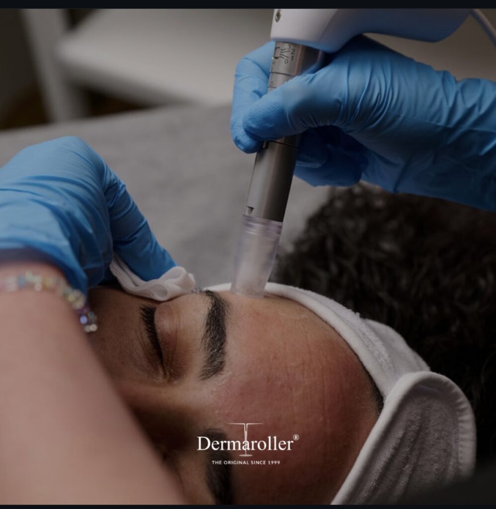 Microneedling